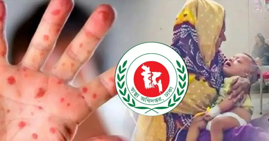 হাম উপসর্গে শিশু মৃ ত্যু বেড়ে ৬