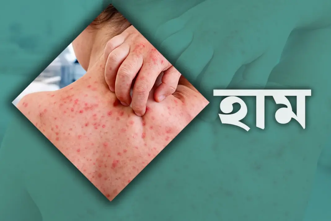 সিলেটে হামে আরও দুই শিশুর মৃত্যু, প্রাণহানি ৭৬ সিলেটে হাম