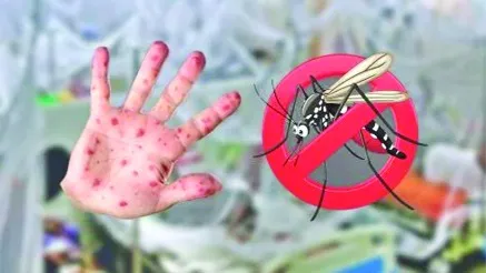 সিলেটে হাম-ডেঙ্গুর একসঙ্গে বিস্তার, বাড়ছে হাসপাতালের চাপ